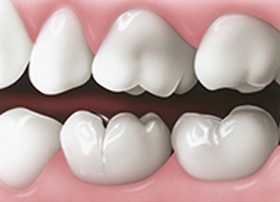 cracked-tooth-01